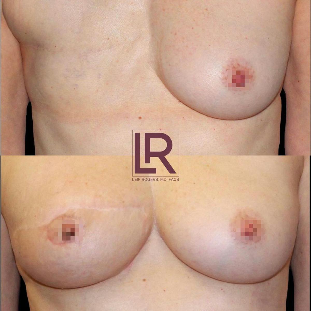 Breast Reconstruction Before & After Gallery - Patient 260433 - Image 1