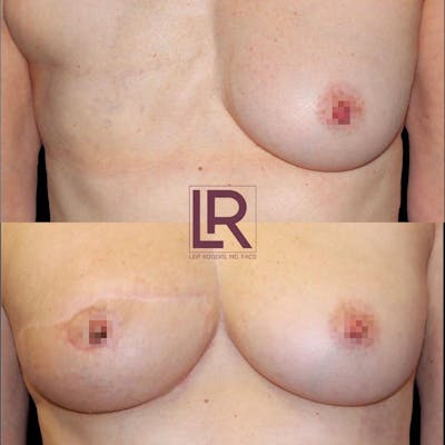 Breast Reconstruction Before & After Gallery - Patient 260433 - Image 1
