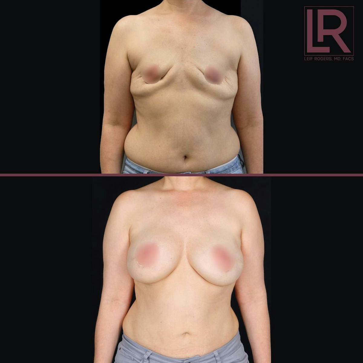 Breast Reconstruction Before & After Gallery - Patient 416542 - Image 1