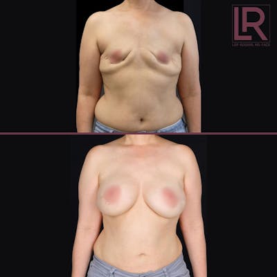 Breast Reconstruction Before & After Gallery - Patient 416542 - Image 1