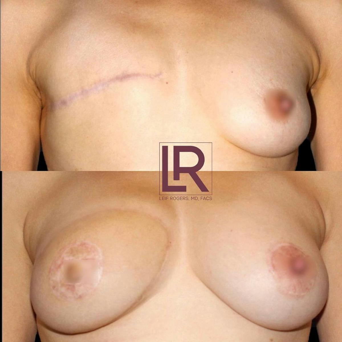 Breast Reconstruction Before & After Gallery - Patient 132399 - Image 1