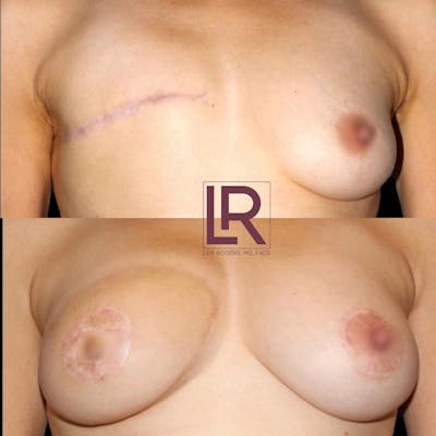 Breast Reconstruction Before & After Gallery - Patient 132399 - Image 1