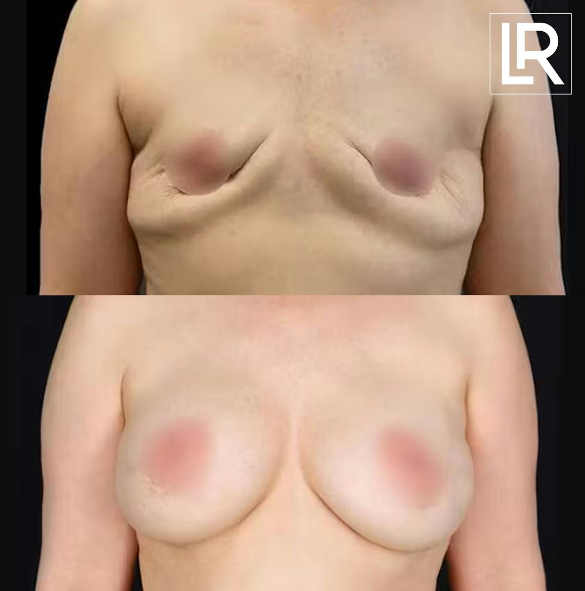 Breast Augmentation Before & After Gallery - Patient 855905 - Image 1