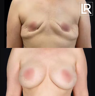 Breast Augmentation Before & After Gallery - Patient 855905 - Image 1