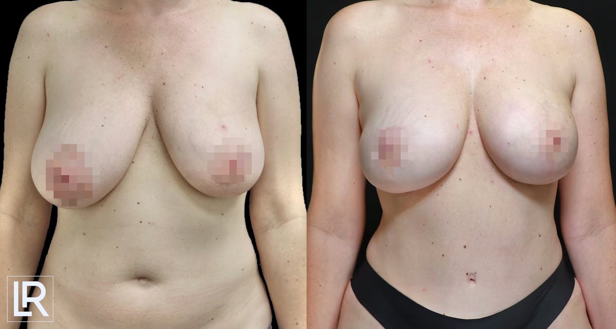 Breast Lift Before & After Gallery - Patient 112286 - Image 1