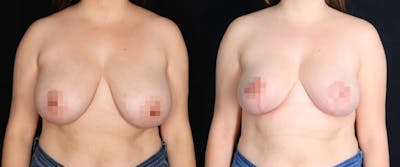 Breast Lift Before & After Gallery - Patient 979940 - Image 1