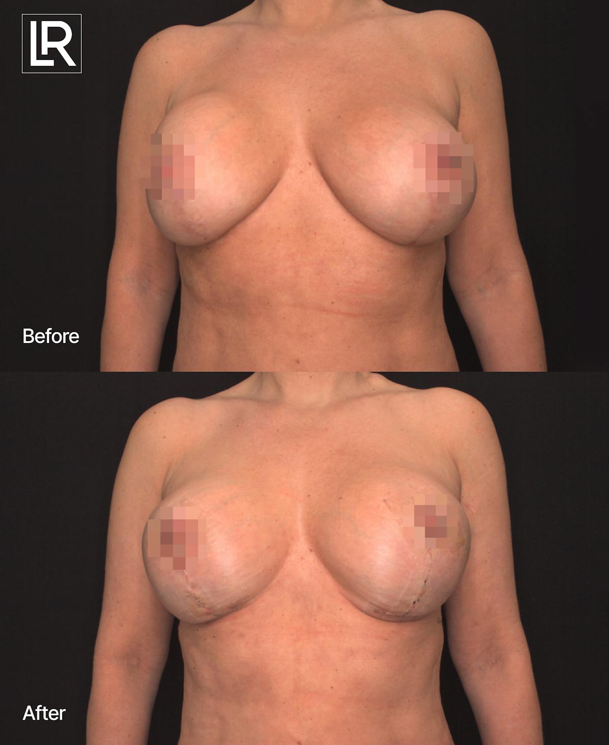 Breast Reconstruction Before & After Gallery - Patient 267238 - Image 1