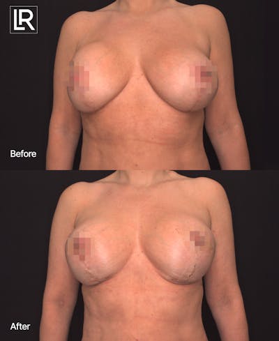 Breast Reconstruction Before & After Gallery - Patient 267238 - Image 1