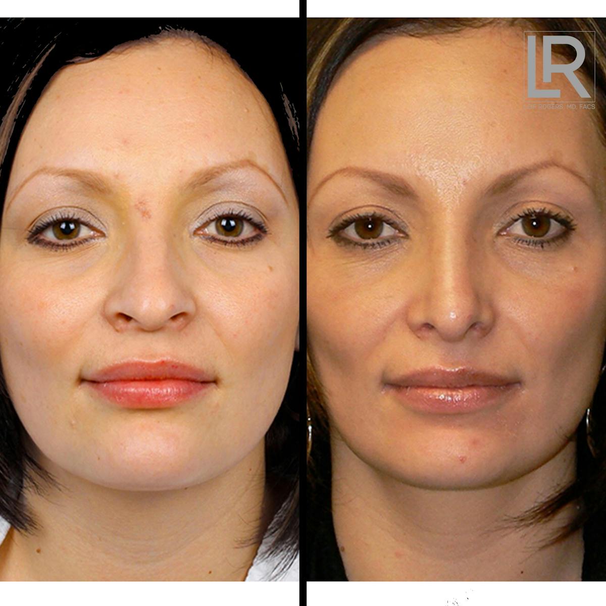 Facelift Female Before & After Gallery - Patient 122908 - Image 1