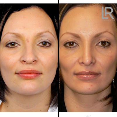 Facelift Female Before & After Gallery - Patient 122908 - Image 1