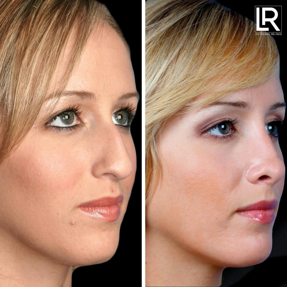 Rhinoplasty Before & After Gallery - Patient 406536 - Image 1