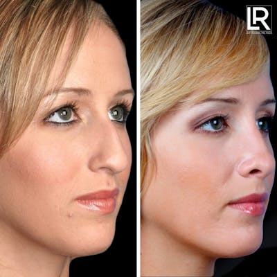 Rhinoplasty Before & After Gallery - Patient 406536 - Image 1