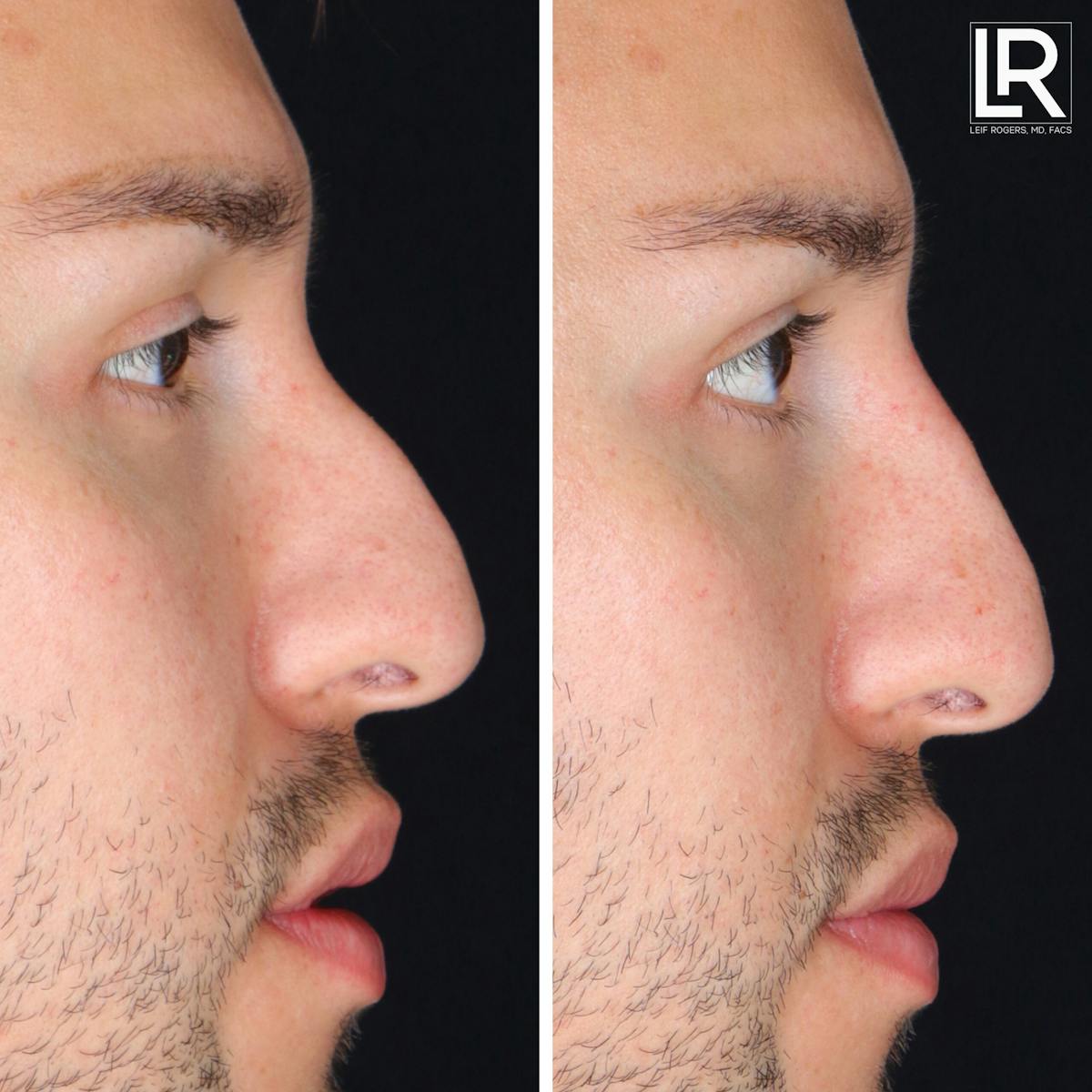 Rhinoplasty Before & After Gallery - Patient 418389 - Image 1