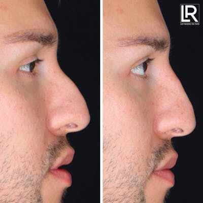 Rhinoplasty Before & After Gallery - Patient 418389 - Image 1