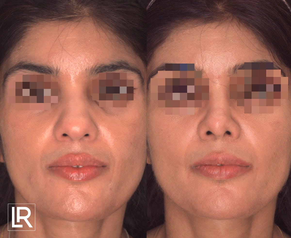 Rhinoplasty Before & After Gallery - Patient 206028 - Image 1