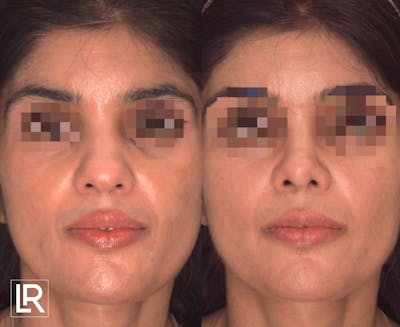 Rhinoplasty Before & After Gallery - Patient 206028 - Image 1