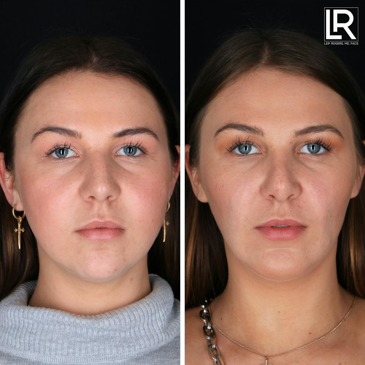 Rhinoplasty Before & After Gallery - Patient 377998 - Image 1