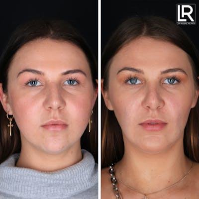 Rhinoplasty Before & After Gallery - Patient 377998 - Image 1