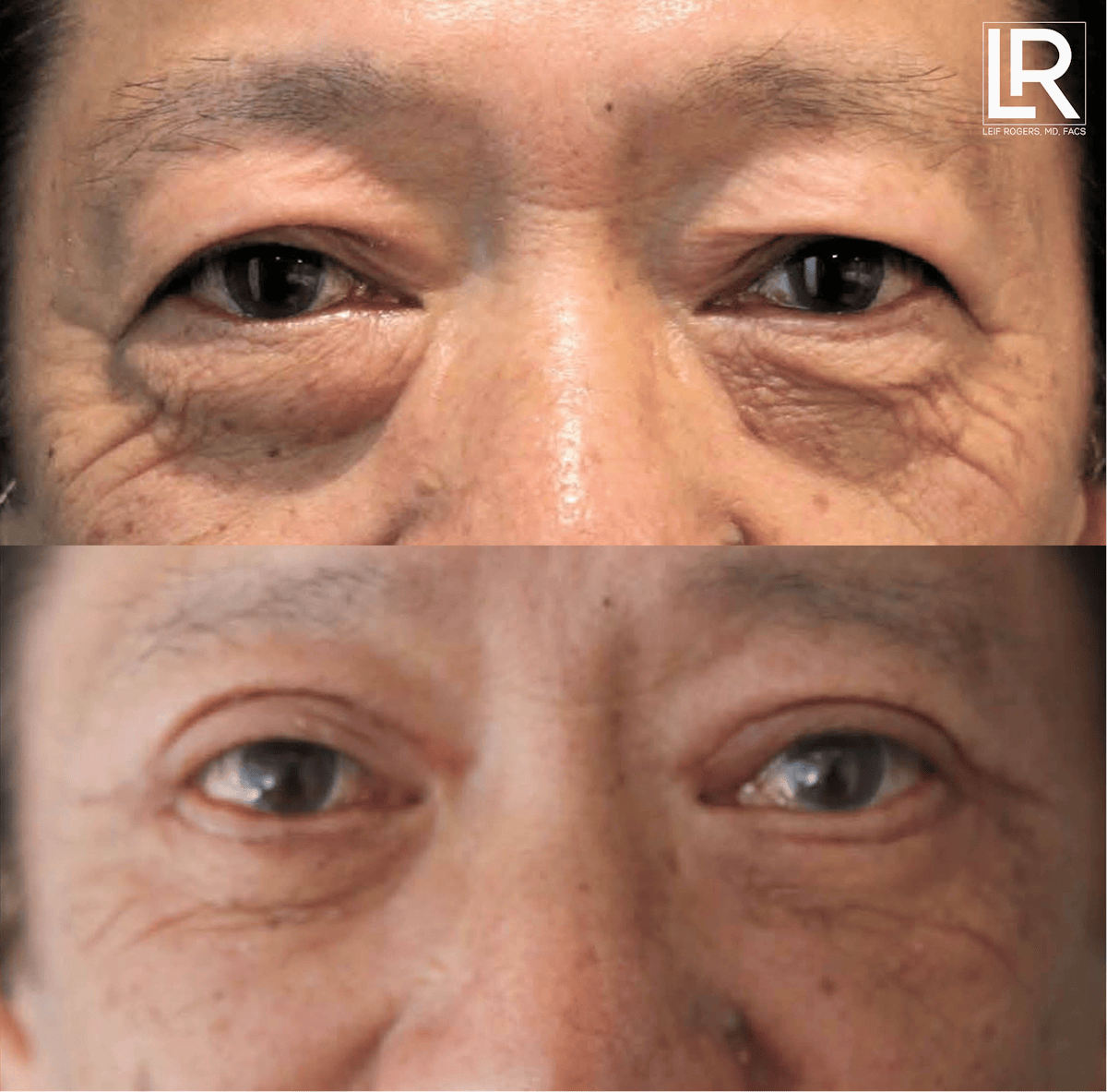 Eyelid Lift Before & After Gallery - Patient 281213 - Image 1