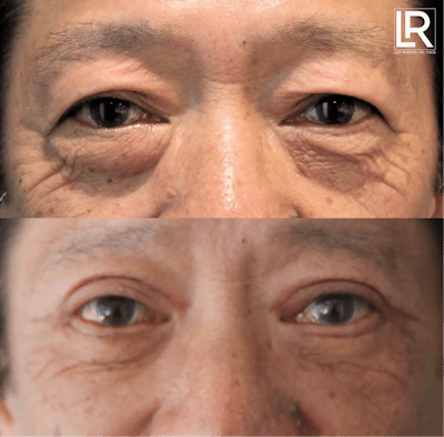 Eyelid Lift Before & After Gallery - Patient 281213 - Image 1