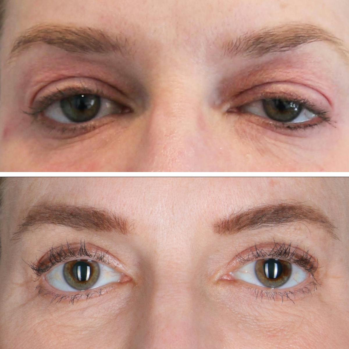 Eyelid Lift Before & After Gallery - Patient 272027 - Image 1