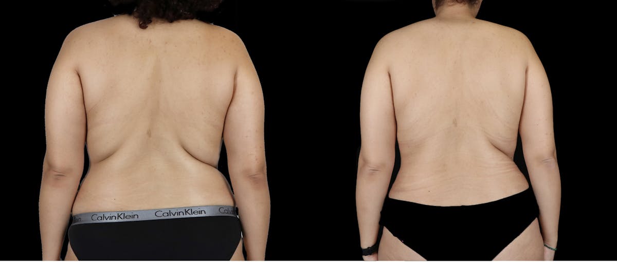 Body Transformation Before & After Gallery - Patient 817729 - Image 3