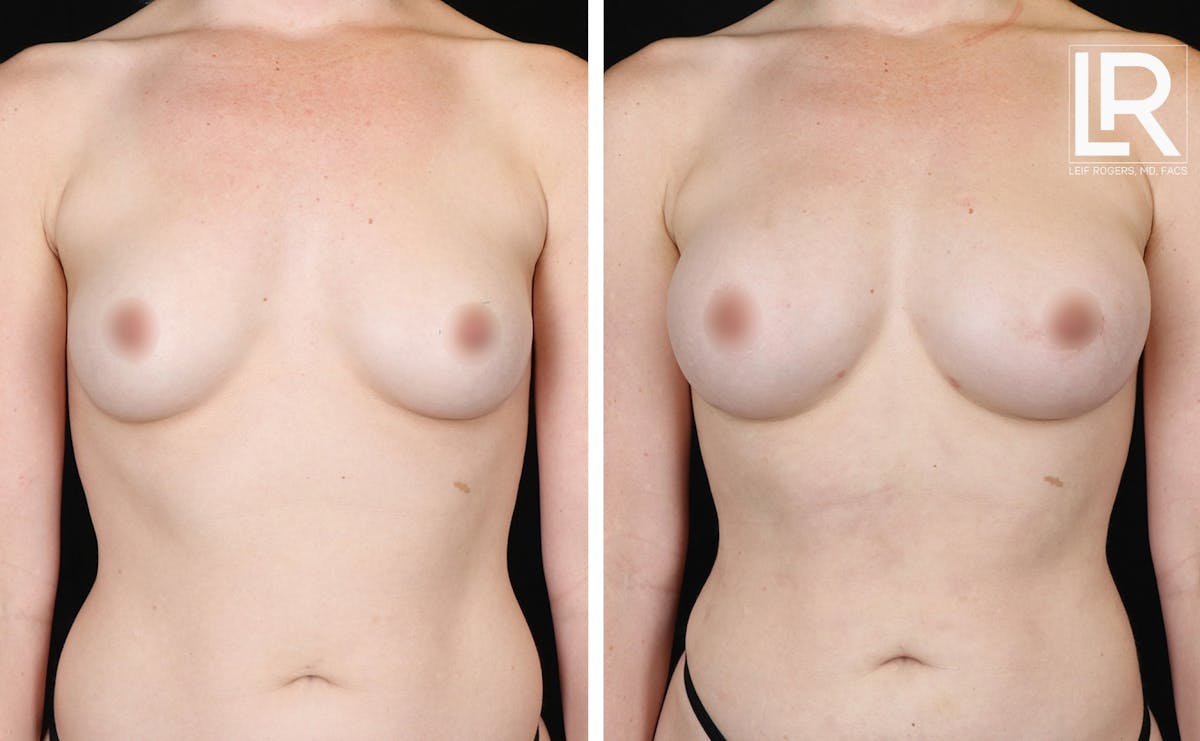 Breast Augmentation Before & After Gallery - Patient 298983 - Image 1