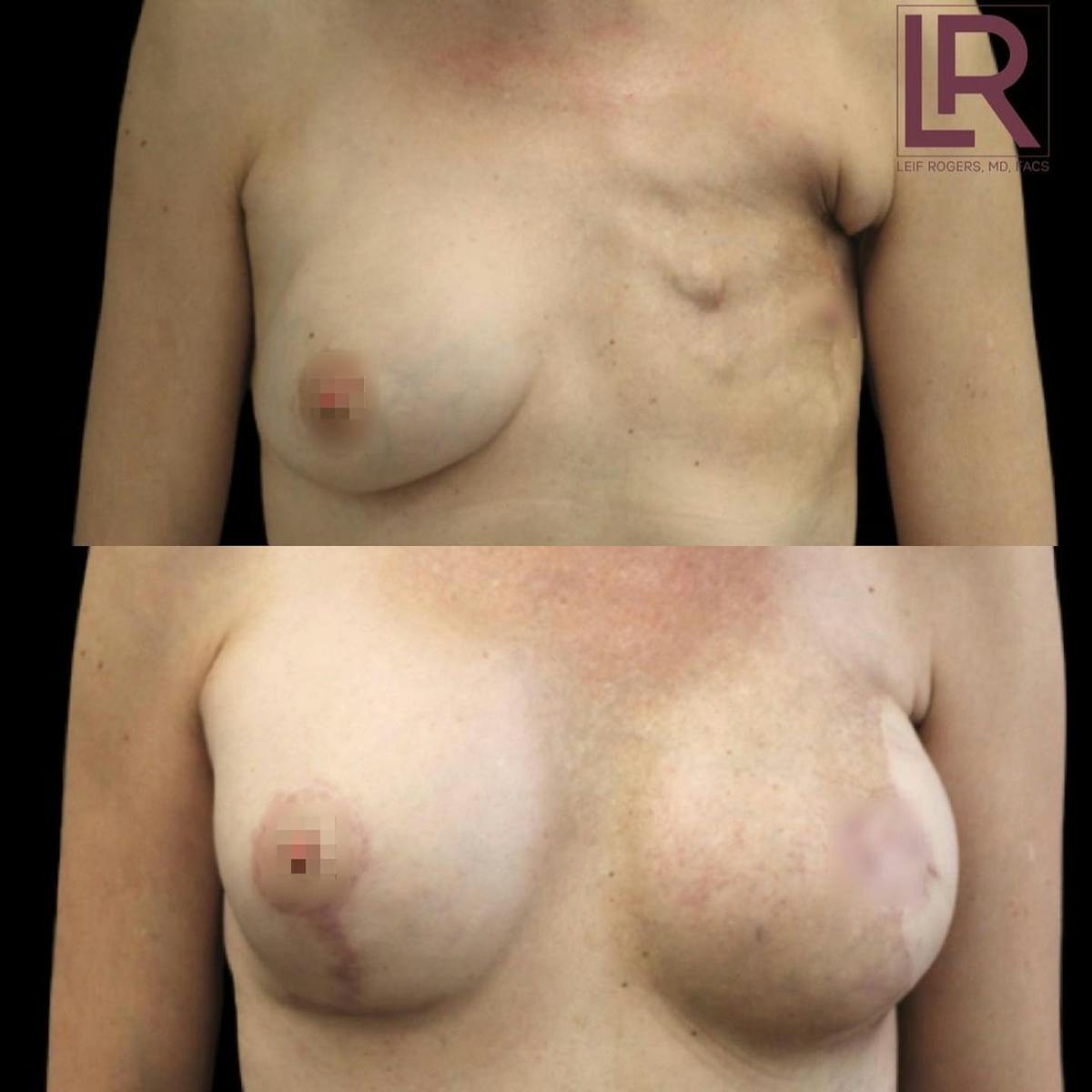 Breast Reconstruction Before & After Gallery - Patient 126888 - Image 1