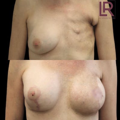 Breast Reconstruction Before & After Gallery - Patient 126888 - Image 1