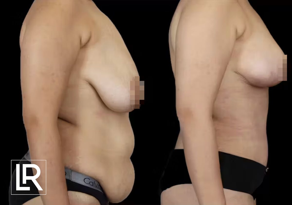 Breast Lift Before & After Gallery - Patient 342545 - Image 1