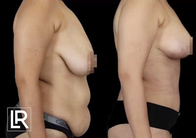 Breast Lift Before & After Gallery - Patient 342545 - Image 1