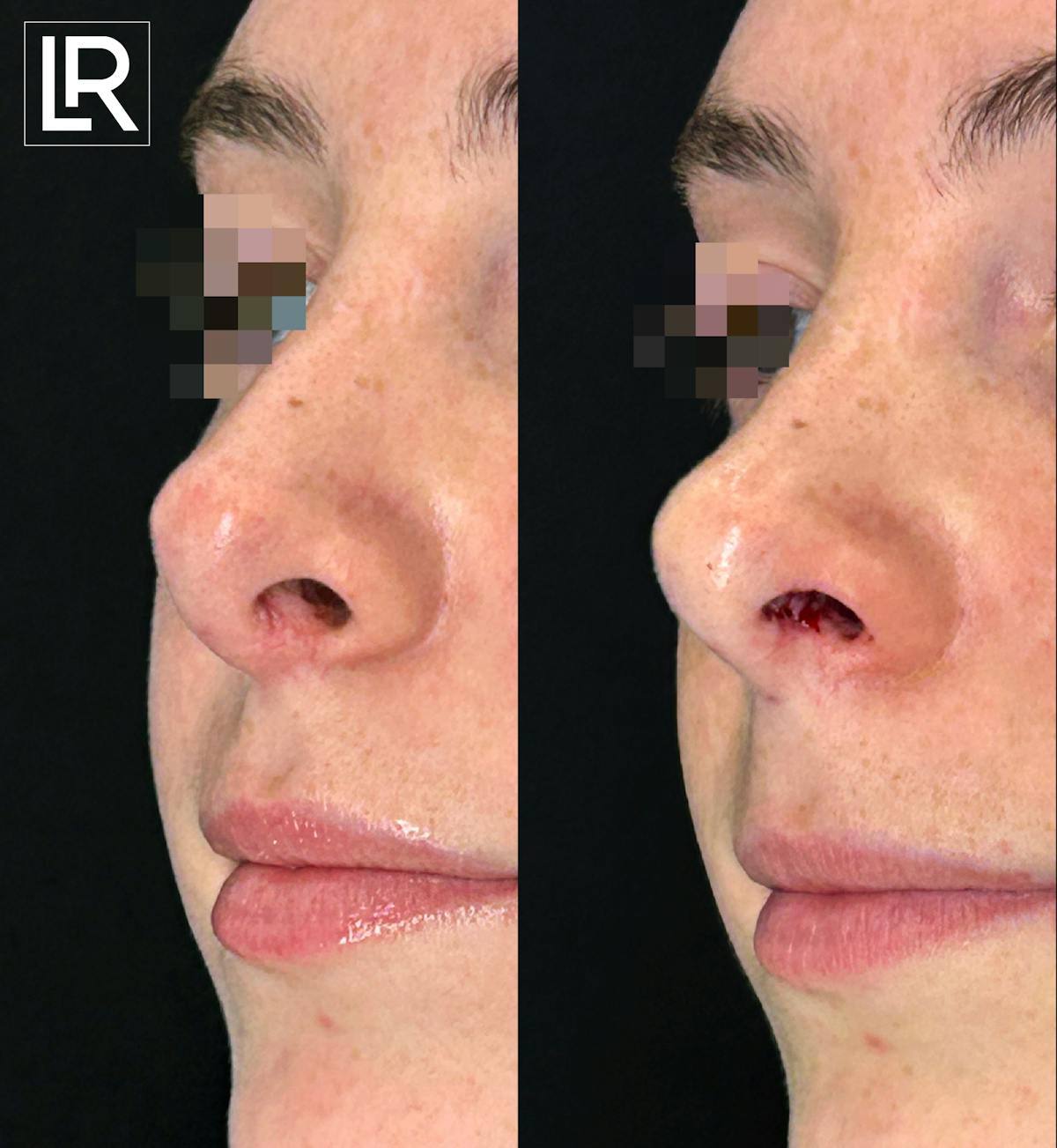 Rhinoplasty Before & After Gallery - Patient 832866 - Image 2