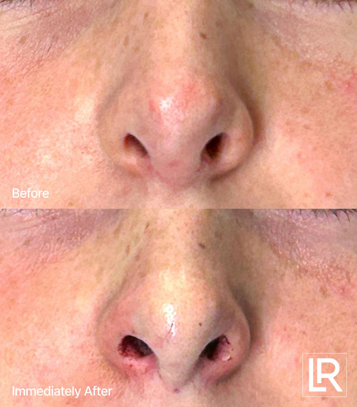 Rhinoplasty Before & After Gallery - Patient 832866 - Image 3