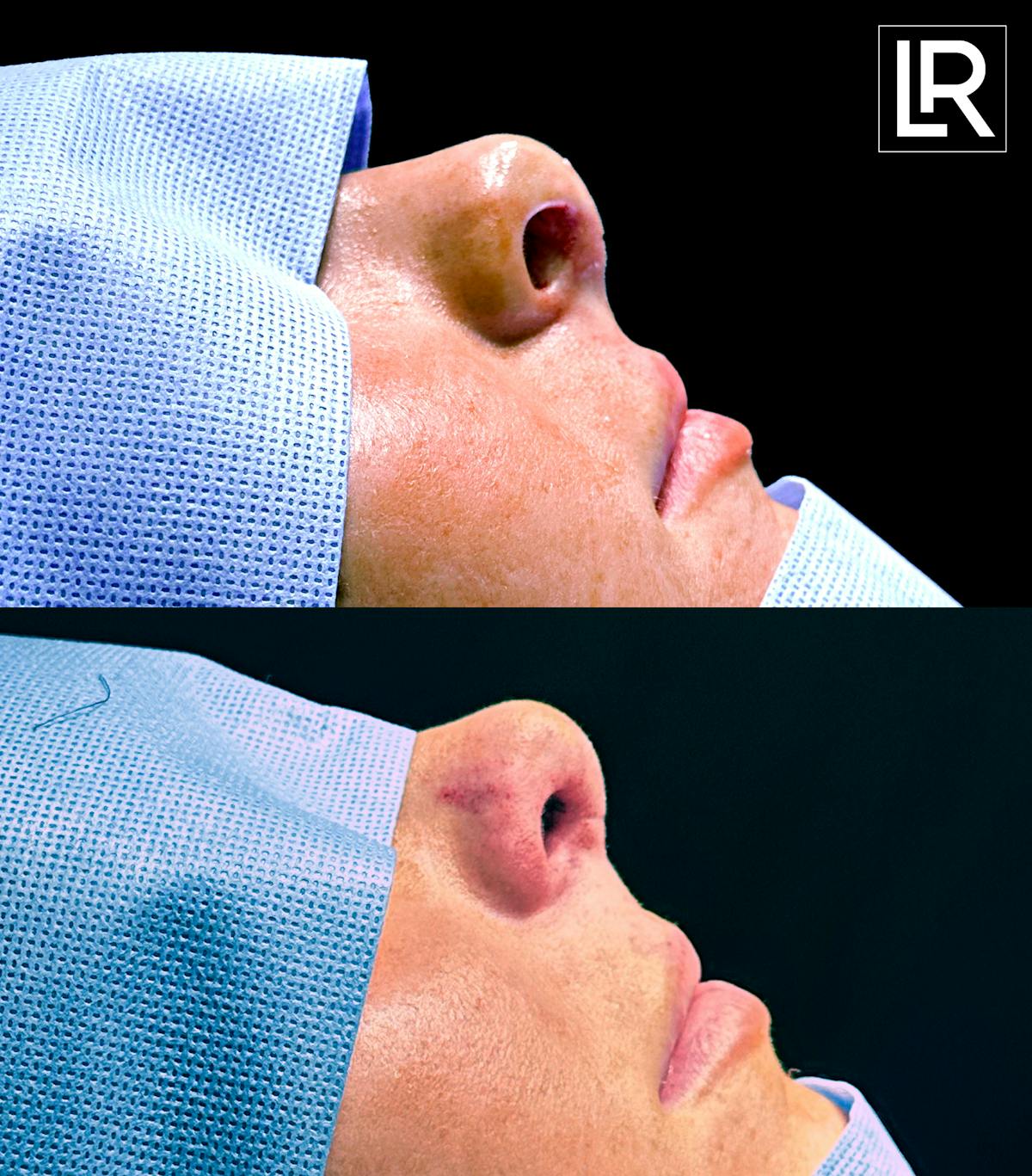 Rhinoplasty Before & After Gallery - Patient 265798 - Image 1