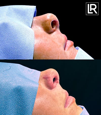 Rhinoplasty Before & After Gallery - Patient 265798 - Image 1