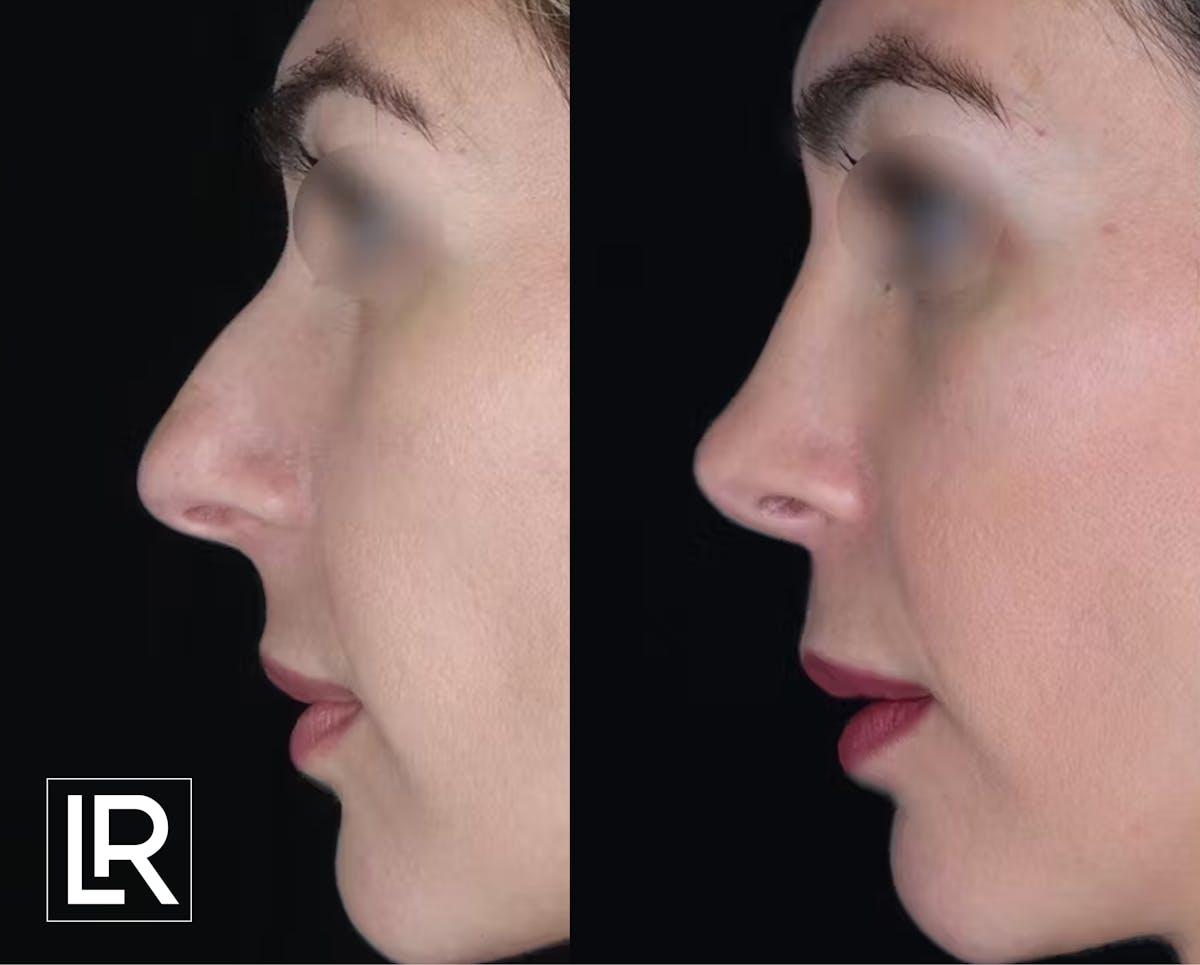 Rhinoplasty Before & After Gallery - Patient 259075 - Image 1