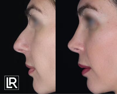 Rhinoplasty Before & After Gallery - Patient 259075 - Image 1