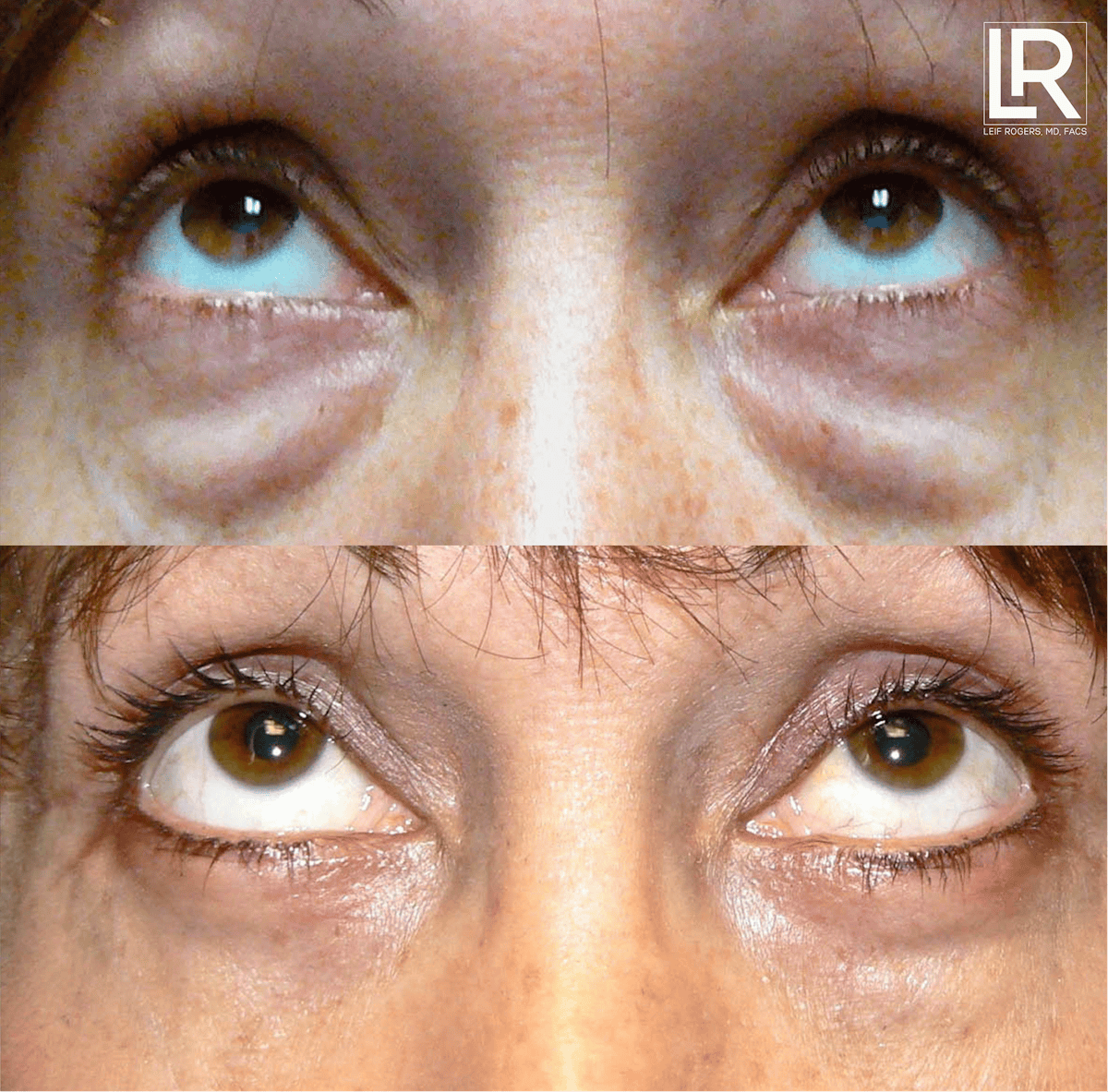 Eyelid Lift Before & After Gallery - Patient 793802 - Image 1