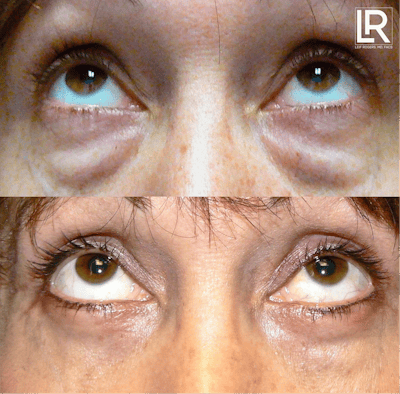 Eyelid Lift Before & After Gallery - Patient 793802 - Image 1