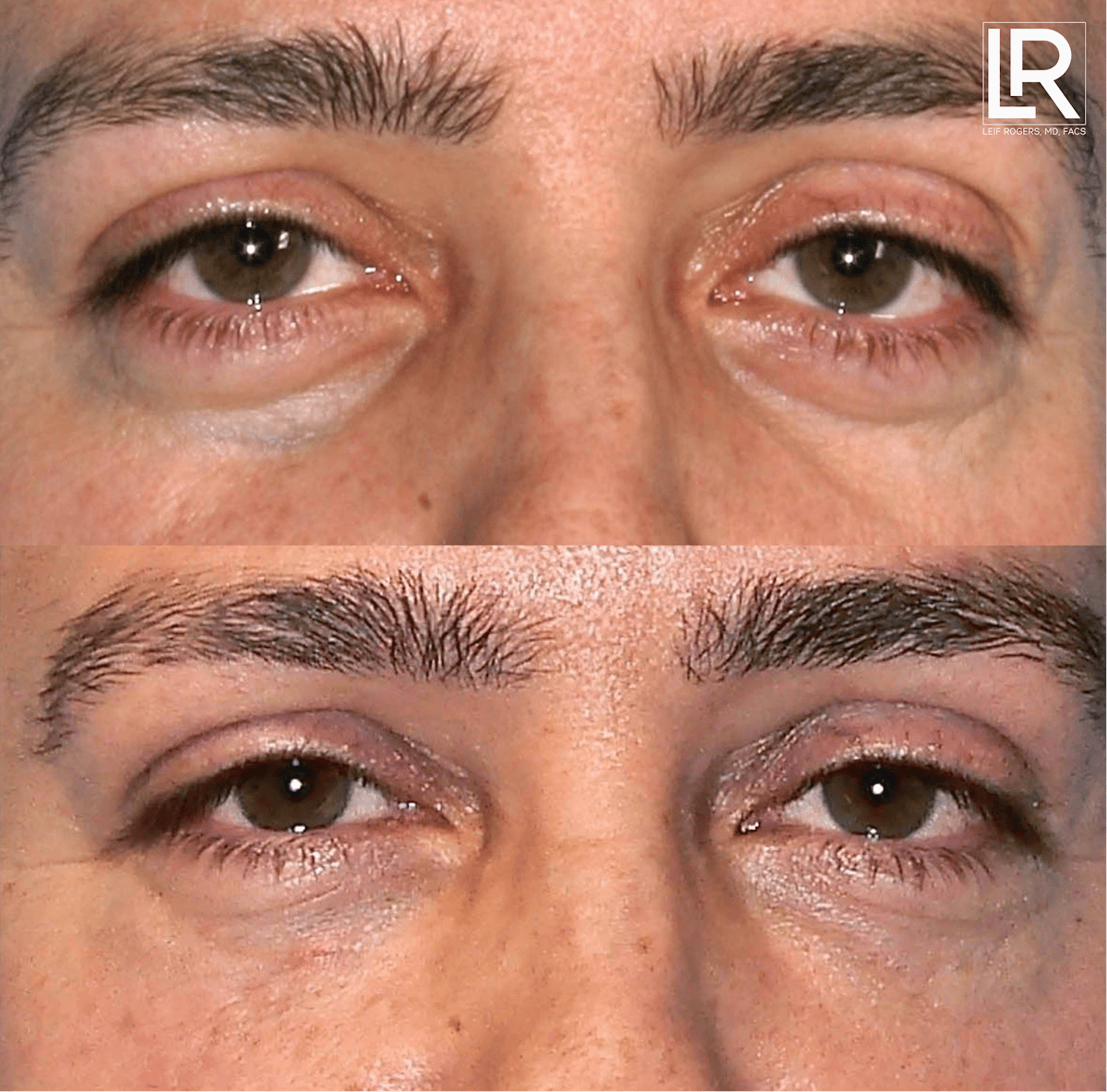 Eyelid Lift Before & After Gallery - Patient 681483 - Image 1