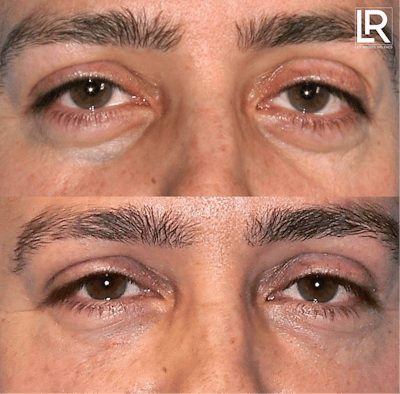 Eyelid Lift Before & After Gallery - Patient 681483 - Image 1