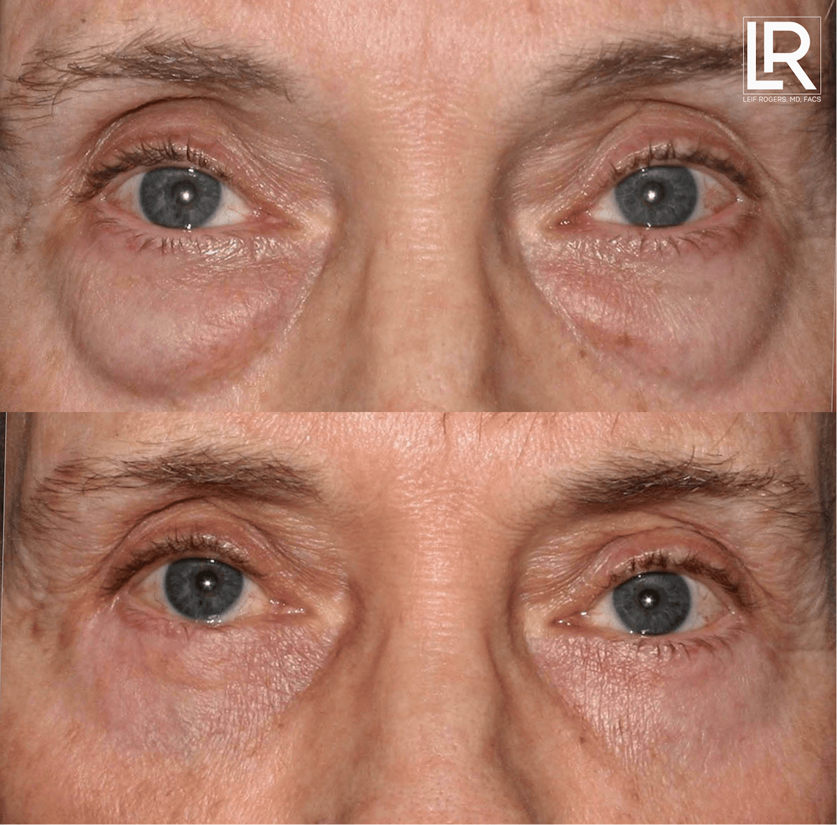Eyelid Lift Before & After Gallery - Patient 833193 - Image 1