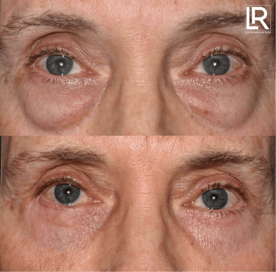 Eyelid Lift Before & After Gallery - Patient 833193 - Image 1