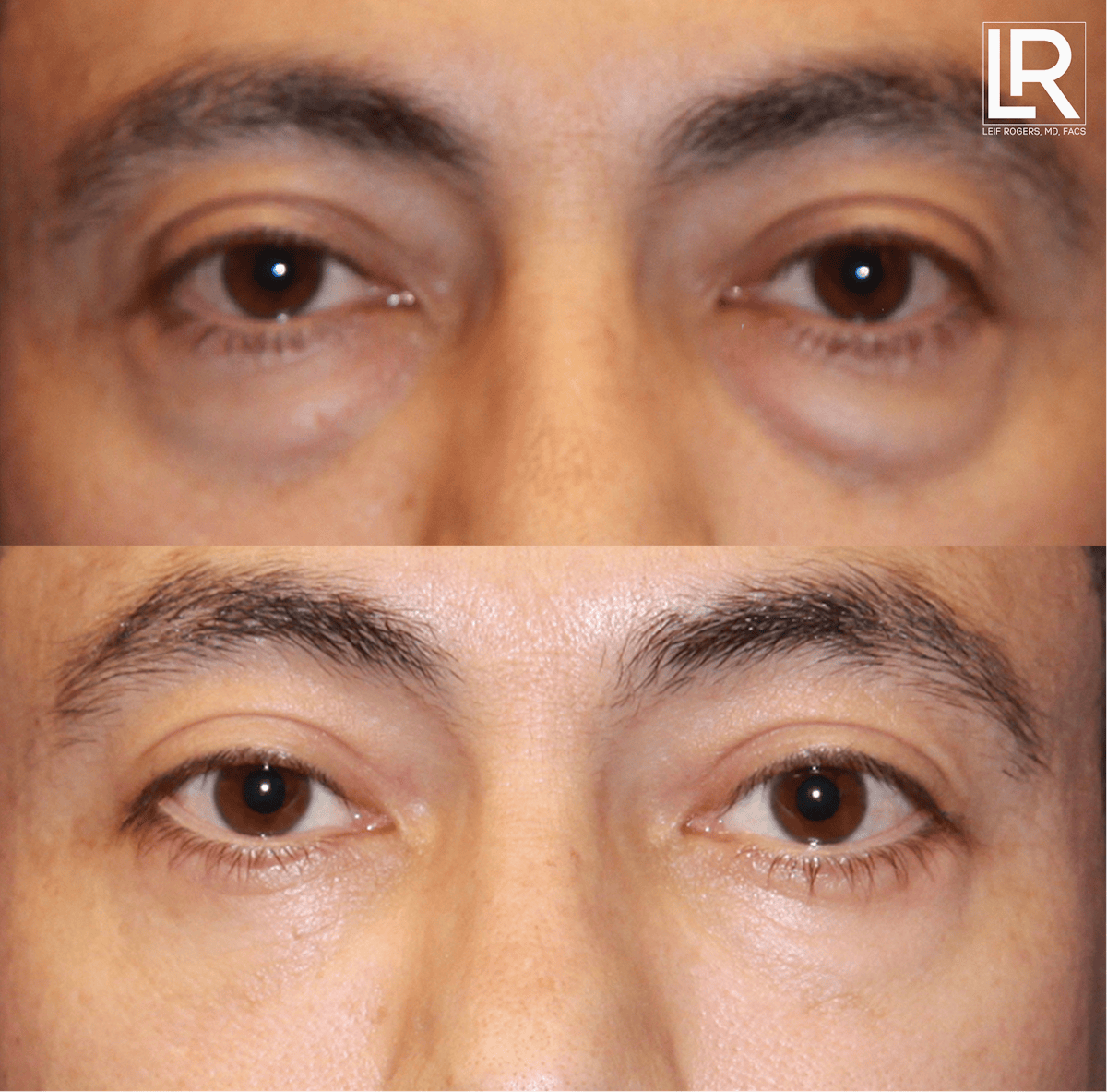 Eyelid Lift Before & After Gallery - Patient 322408 - Image 1