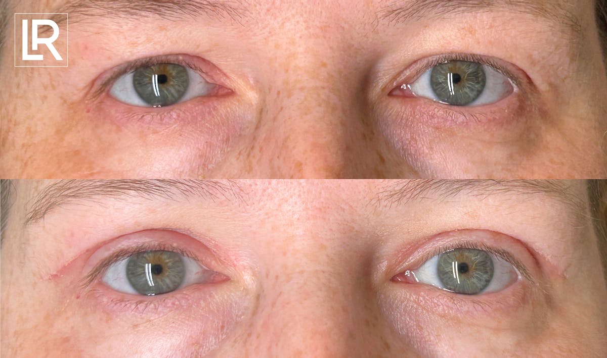 Eyelid Lift Before & After Gallery - Patient 102608 - Image 1