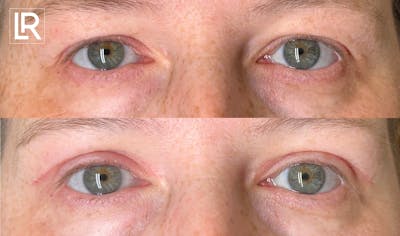 Eyelid Lift Before & After Gallery - Patient 102608 - Image 1