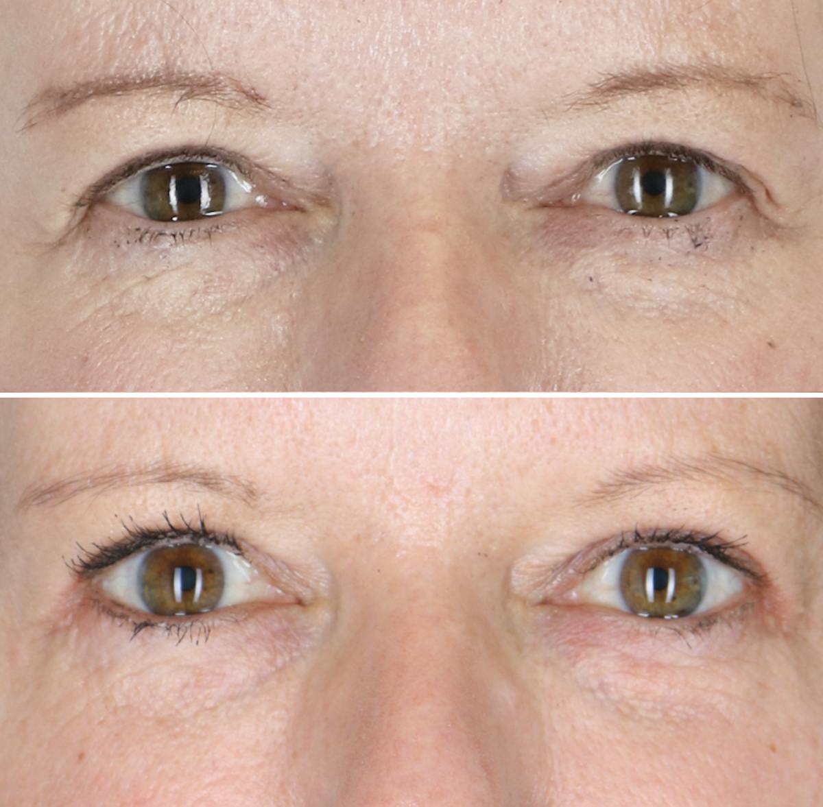 Eyelid Lift Before & After Gallery - Patient 309077 - Image 1