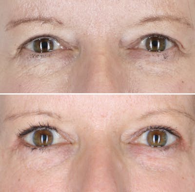 Eyelid Lift Before & After Gallery - Patient 309077 - Image 1