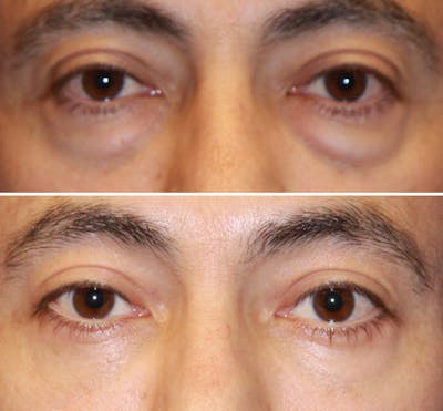 Eyelid Lift Before & After Gallery - Patient 407897 - Image 1