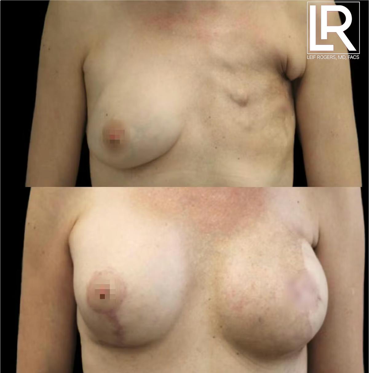 Breast Augmentation Before & After Gallery - Patient 351291 - Image 1